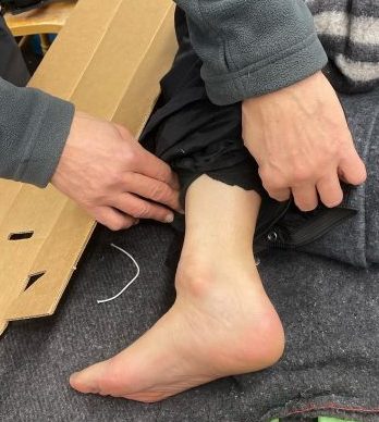 Splinting a broken ankle